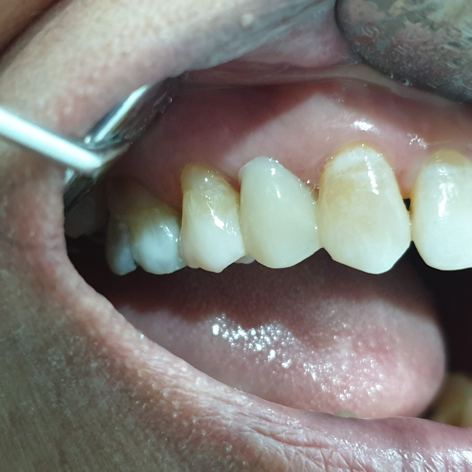 FRC Bridge, again! Dr. Nik Klinik Pergigian Fauziah