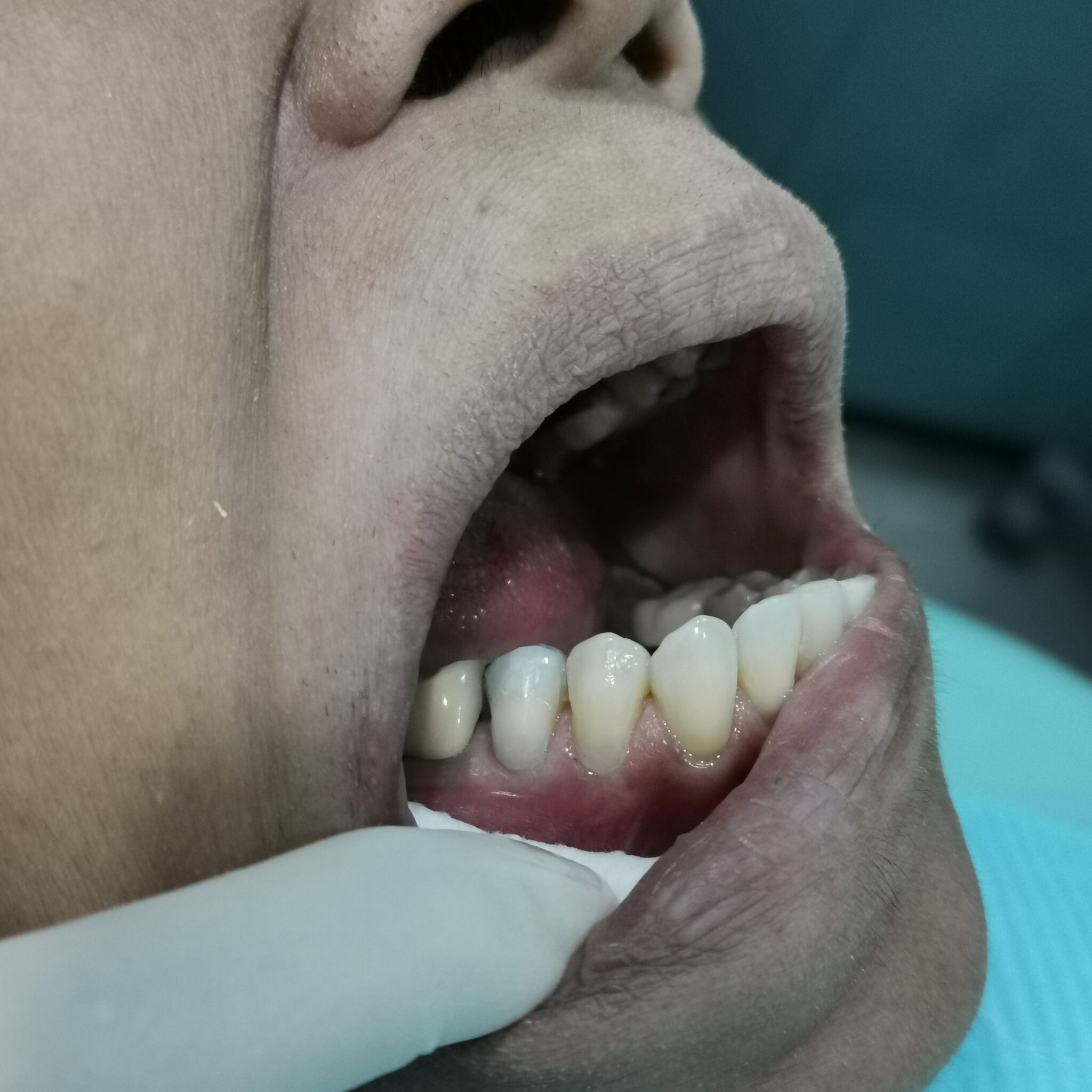 ABRASION CAVITY : DR. DINI – Klinik Pergigian Fauziah